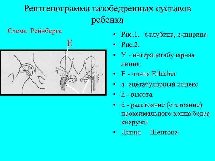 Рентгенограмма тазобедренных суставов ребенка Схема Рейнберга Е • Рис. 1. t-глубина, e-ширина • Рис.