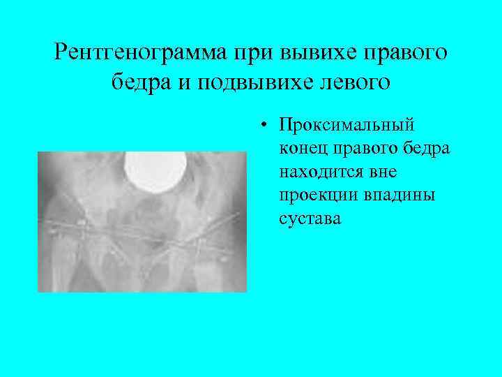 Рентгенограмма при вывихе правого бедра и подвывихе левого • Проксимальный конец правого бедра находится