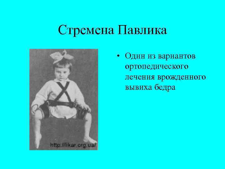 Стремена Павлика • Один из вариантов ортопедического лечения врожденного вывиха бедра 