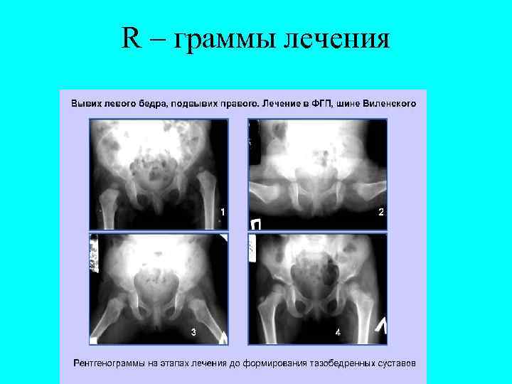 R – граммы лечения 