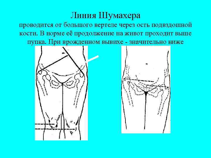 Паховые складки где находятся схема у женщин