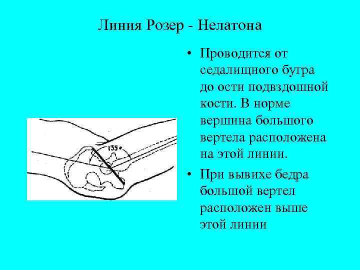 Линия Розер - Нелатона • Проводится от седалищного бугра до ости подвздошной кости. В