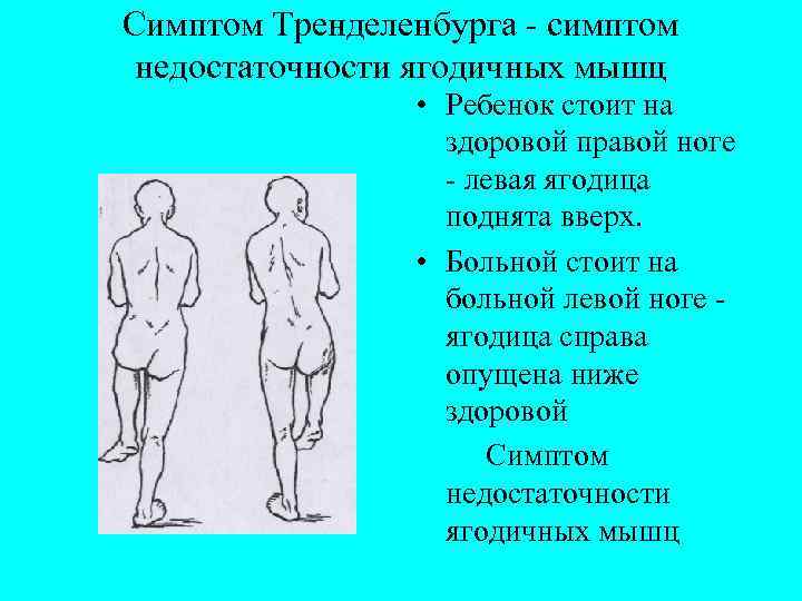 Симптом Тренделенбурга - симптом недостаточности ягодичных мышц • Ребенок стоит на здоровой правой ноге