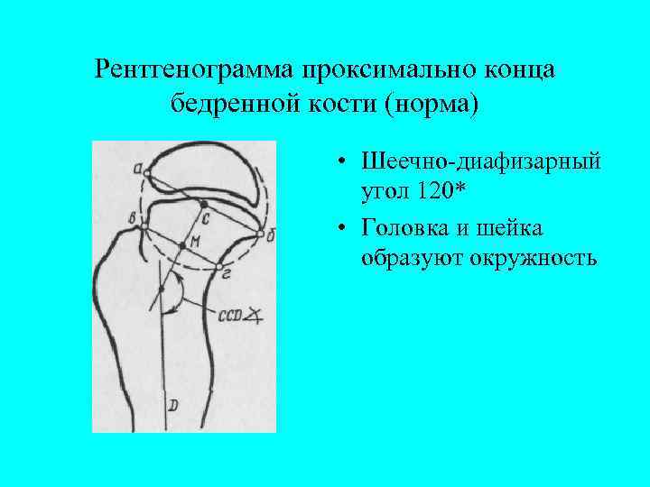 Рентгенограмма проксимально конца бедренной кости (норма) • Шеечно-диафизарный угол 120* • Головка и шейка