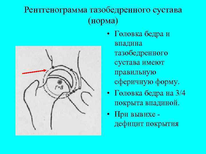 Рентгенограмма тазобедренного сустава (норма) • Головка бедра и впадина тазобедренного сустава имеют правильную сферичную