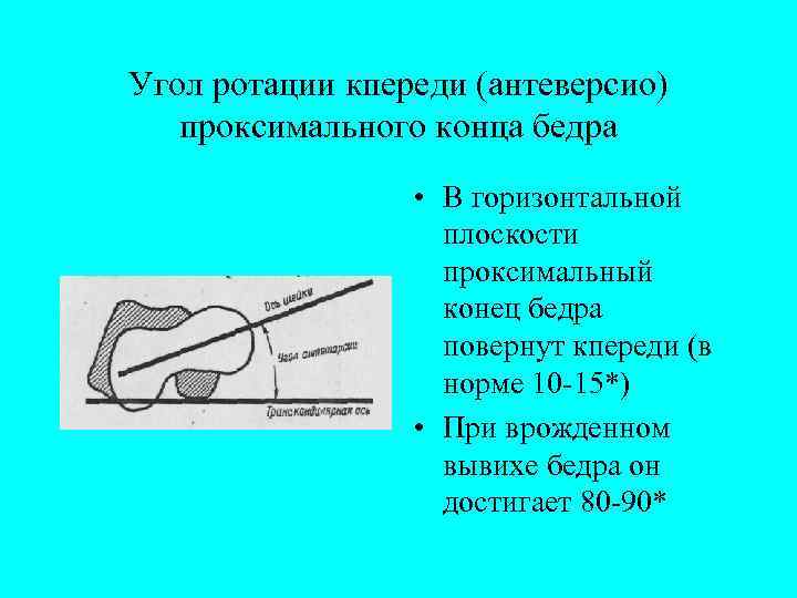 Угол ротации кпереди (антеверсио) проксимального конца бедра • В горизонтальной плоскости проксимальный конец бедра