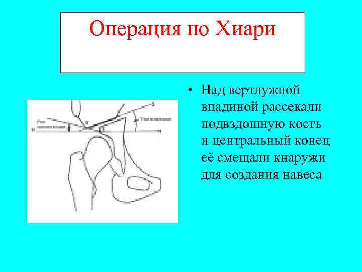 Операция по Хиари • Над вертлужной впадиной рассекали подвздошную кость и центральный конец её