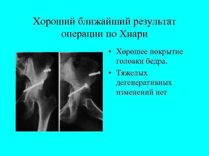 Хороший ближайший результат операции по Хиари • Хорошее покрытие головки бедра. • Тяжелых дегенеративных