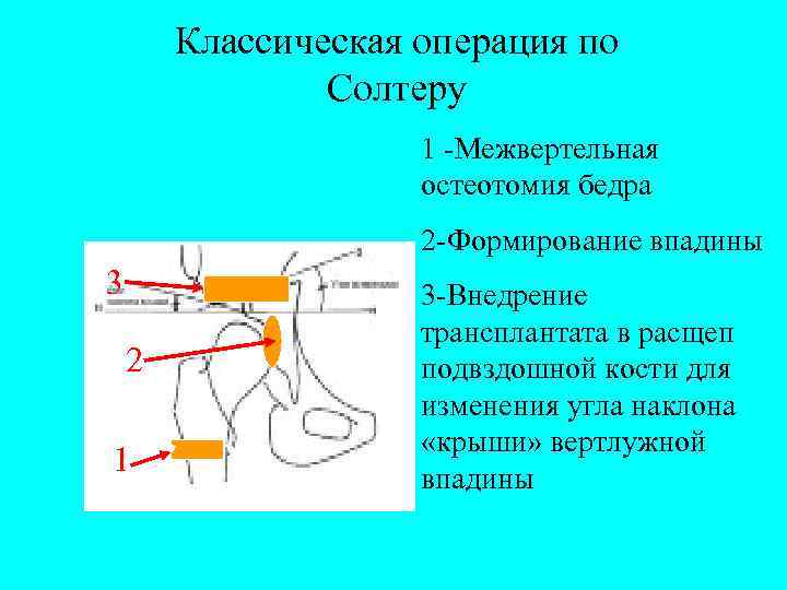 Классическая операция по Солтеру 1 -Межвертельная остеотомия бедра 2 -Формирование впадины 3 2 1