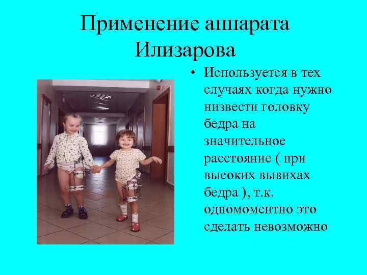 Применение аппарата Илизарова • Используется в тех случаях когда нужно низвести головку бедра на