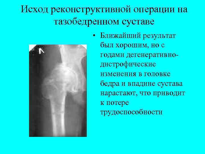 Исход реконструктивной операции на тазобедренном суставе • Ближайший результат был хорошим, но с годами