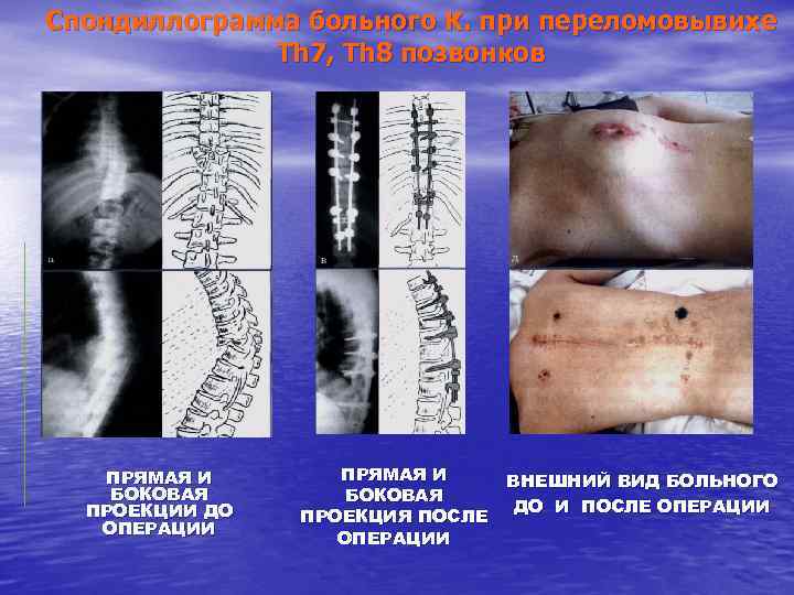 Спондиллограмма больного К. при переломовывихе Th 7, Th 8 позвонков ПРЯМАЯ И БОКОВАЯ ПРОЕКЦИИ