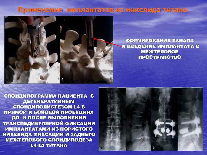 Применение имплантатов из никелида титана ФОРМИРОВАНИЕ КАНАЛА И ВВЕДЕНИЕ ИМПЛАНТАТА В МЕЖТЕЛОВОЕ ПРОСТРАНСТВО СПОНДИЛОГРАММА