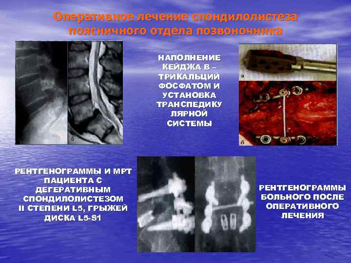 Оперативное лечение спондилолистеза поясничного отдела позвоночника НАПОЛНЕНИЕ КЕЙДЖА B – ТРИКАЛЬЦИЙ ФОСФАТОМ И УСТАНОВКА