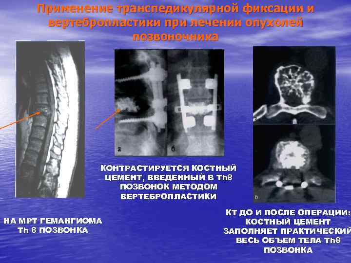 Гемангиома th12 позвонка что