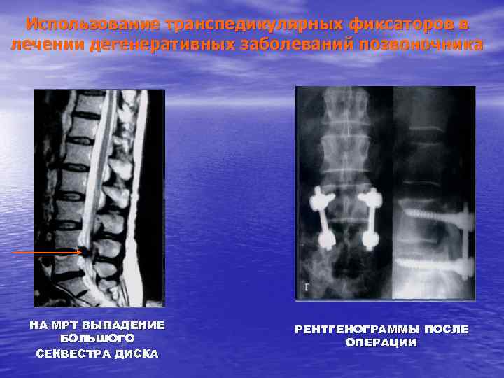 Использование транспедикулярных фиксаторов в лечении дегенеративных заболеваний позвоночника НА МРТ ВЫПАДЕНИЕ БОЛЬШОГО СЕКВЕСТРА ДИСКА