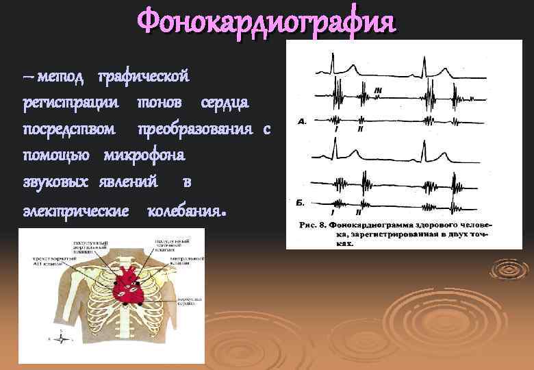 Фонокардиография – метод графической регистрации тонов сердца посредством преобразования с помощью микрофона звуковых явлений