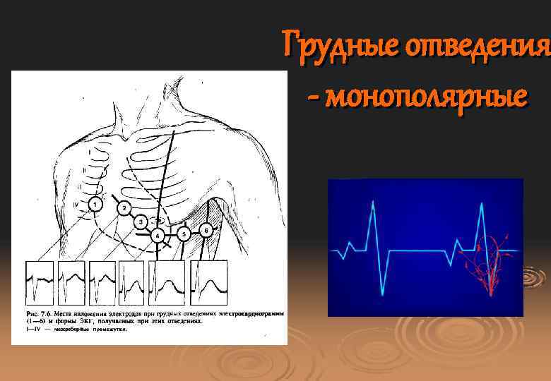 Грудные отведения - монополярные 