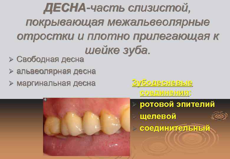 ДЕСНА-часть слизистой, покрывающая межальвеолярные отростки и плотно прилегающая к шейке зуба. Свободная десна Ø