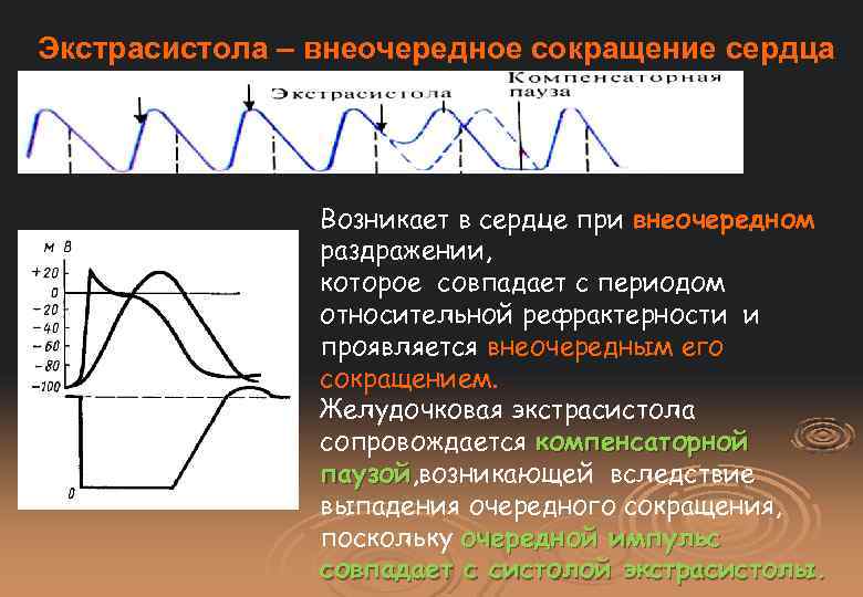 Экстрасистола – внеочередное сокращение сердца Возникает в сердце при внеочередном раздражении, которое совпадает с