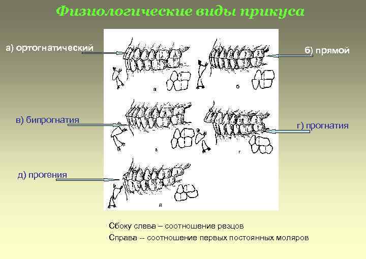 Физиологические виды прикуса а) ортогнатический в) бипрогнатия б) прямой г) прогнатия д) прогения Сбоку