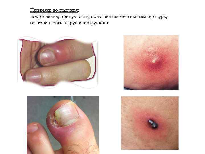 Признаки воспаления: покраснение, припухлость, повышенная местная температура, болезненность, нарушение функции 