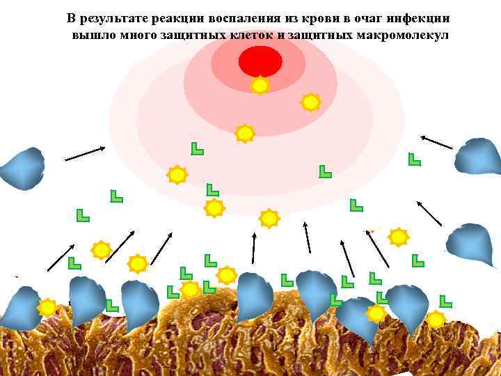 В результате реакции воспаления из крови в очаг инфекции вышло много защитных клеток и