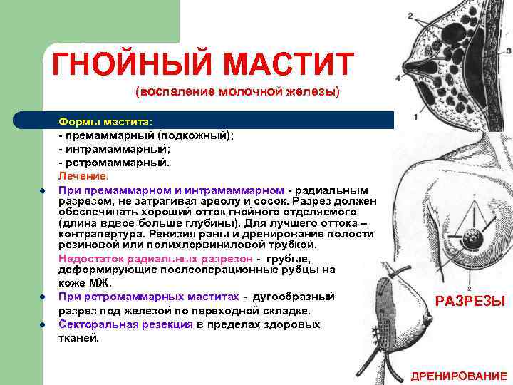 ГНОЙНЫЙ МАСТИТ (воспаление молочной железы) l l Формы мастита: - премаммарный (подкожный); - интрамаммарный;