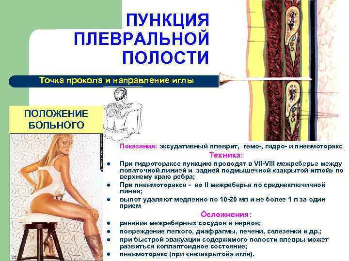 ПУНКЦИЯ ПЛЕВРАЛЬНОЙ ПОЛОСТИ Точка прокола и направление иглы ПОЛОЖЕНИЕ БОЛЬНОГО Показания: эксудативный плеврит, гемо-,