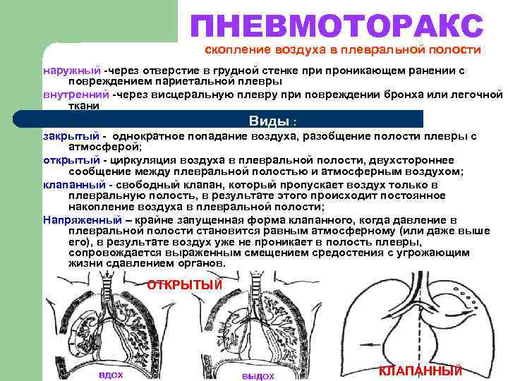 ПНЕВМОТОРАКС скопление воздуха в плевральной полости наружный -через отверстие в грудной стенке при проникающем