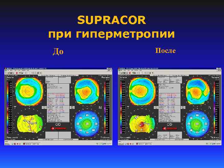 SUPRACOR при гиперметропии До После 