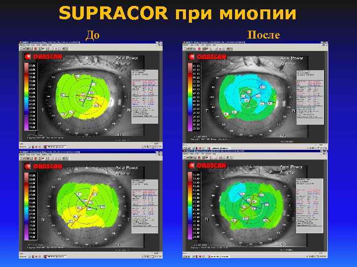 SUPRACOR при миопии До После 