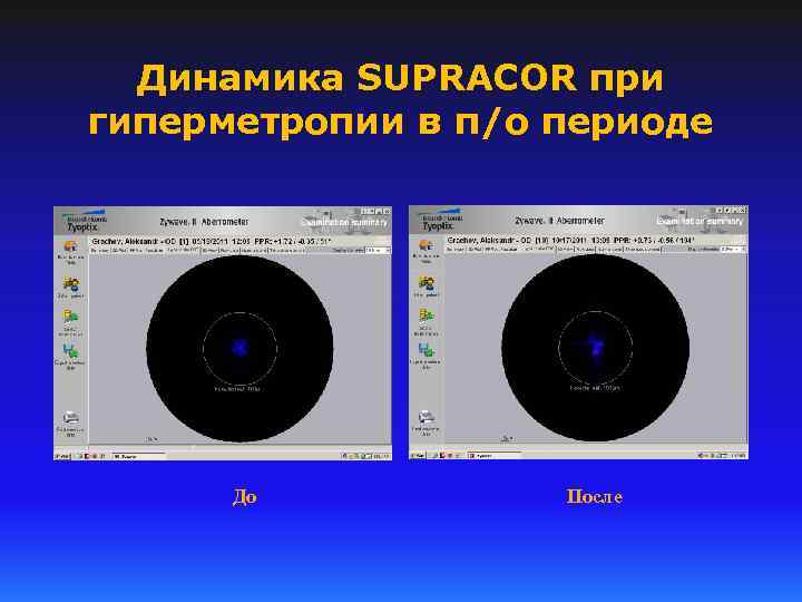 Динамика SUPRACOR при гиперметропии в п/о периоде До После 