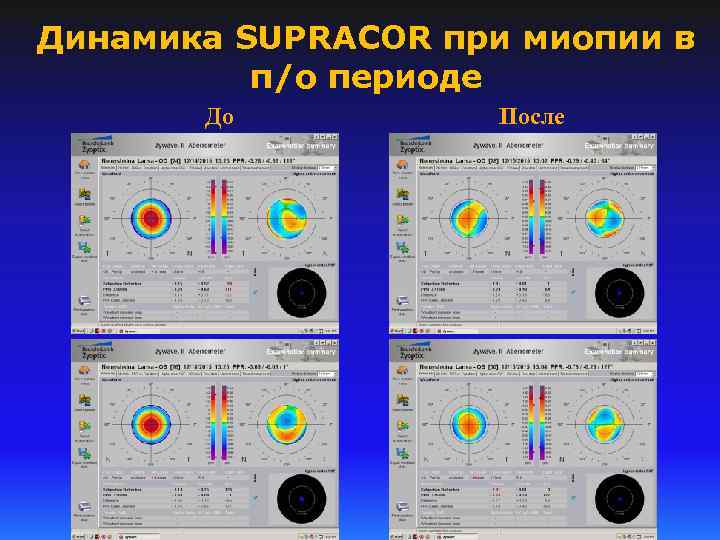 Динамика SUPRACOR при миопии в п/о периоде До После 