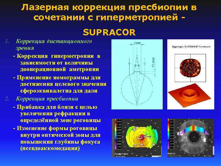 Лазерная коррекция пресбиопии в сочетании с гиперметропией SUPRACOR Коррекция дистанционного зрения - Коррекция гиперметропии