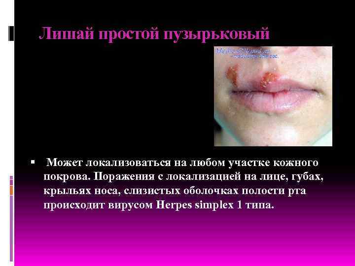 Лишай простой пузырьковый Может локализоваться на любом участке кожного покрова. Поражения с локализацией на