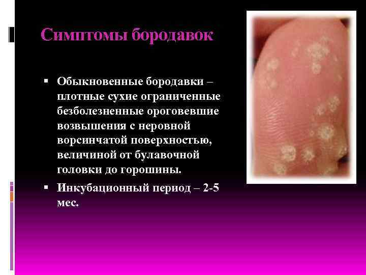 Симптомы бородавок Обыкновенные бородавки – плотные сухие ограниченные безболезненные ороговевшие возвышения с неровной ворсинчатой