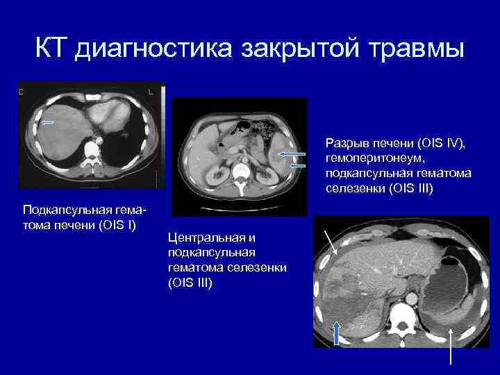 КТ диагностика закрытой травмы Разрыв печени (OIS IV), гемоперитонеум, подкапсульная гематома селезенки (OIS III)