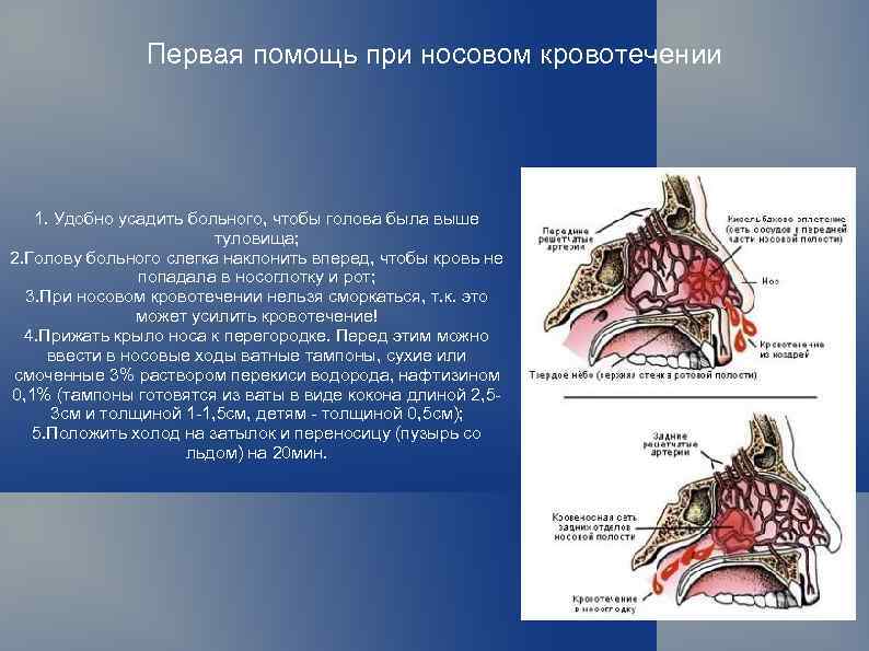 Первая помощь при носовом кровотечении 1. Удобно усадить больного, чтобы голова была выше туловища;