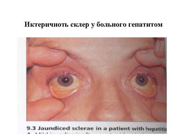 Иктеричноть склер у больного гепатитом 