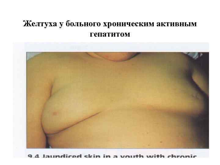 Желтуха у больного хроническим активным гепатитом 