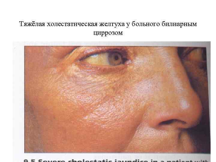 Тяжёлая холестатическая желтуха у больного билиарным циррозом 