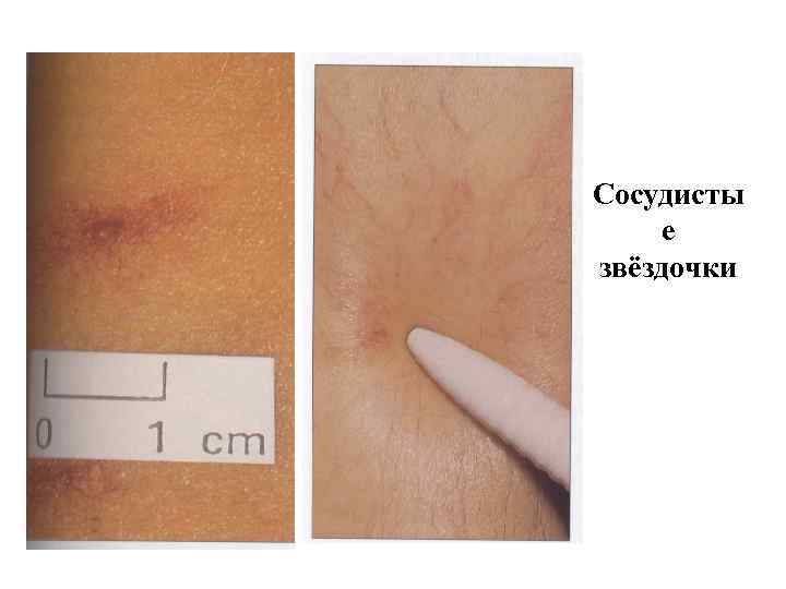 Сосудисты е звёздочки 