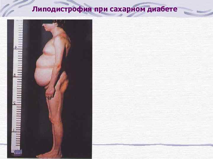 Липодистрофия при сахарном диабете 