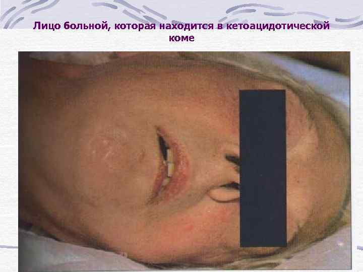 Лицо больной, которая находится в кетоацидотической коме 