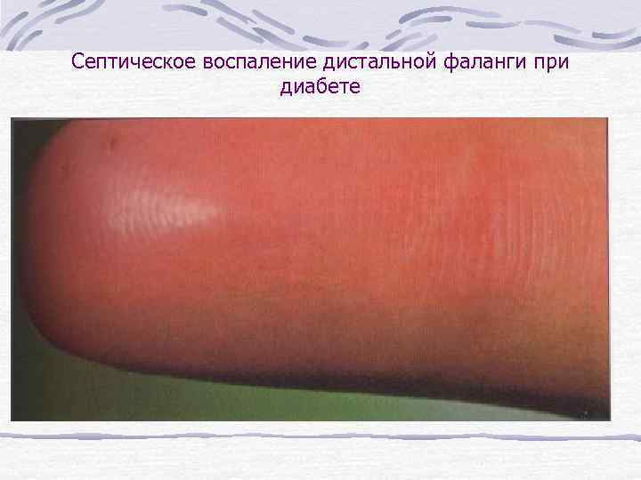 Септическое воспаление дистальной фаланги при диабете 