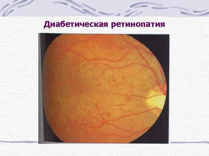 Диабетическая ретинопатия 