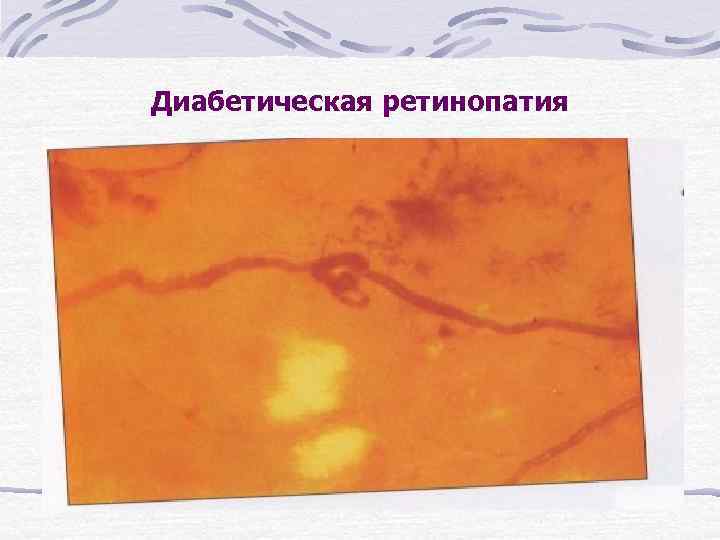 Диабетическая ретинопатия 