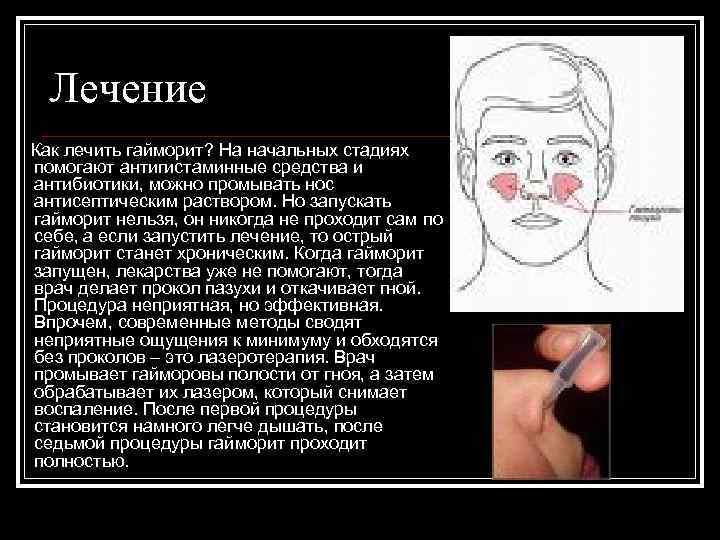 Лечение Как лечить гайморит? На начальных стадиях помогают антигистаминные средства и антибиотики, можно промывать