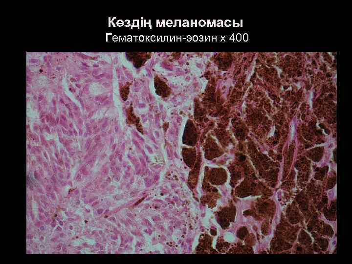 Көздің меланомасы Гематоксилин-эозин х 400 